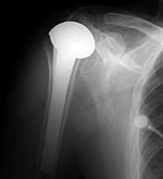 Shoulder hemiarthroplasty